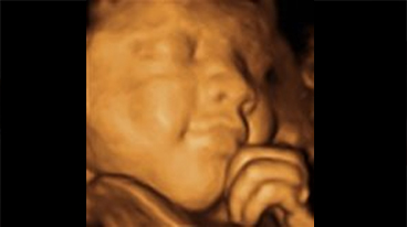 3D ultrasound image of a baby's face in profile